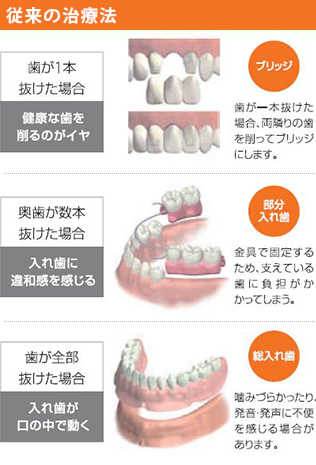 インプラント 従来の治療方法
