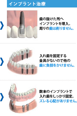 インプラント治療
