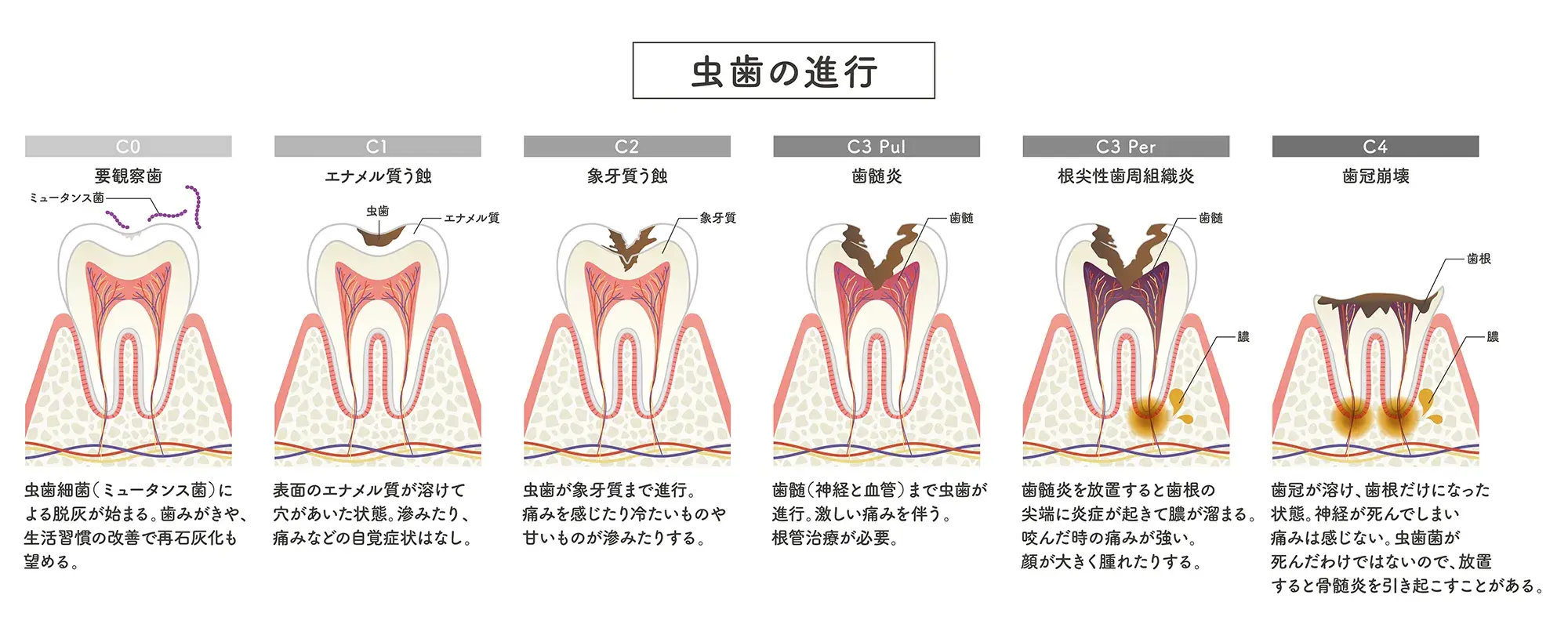 虫歯の治療法について