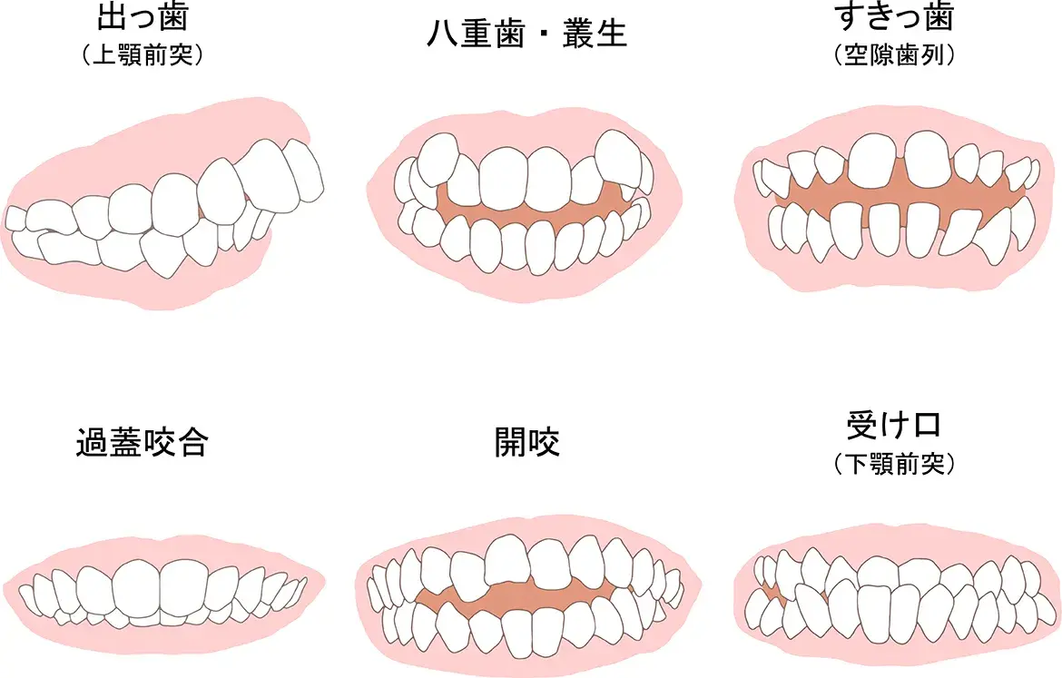 歯並び・噛み合わせが悪いとどうなる?