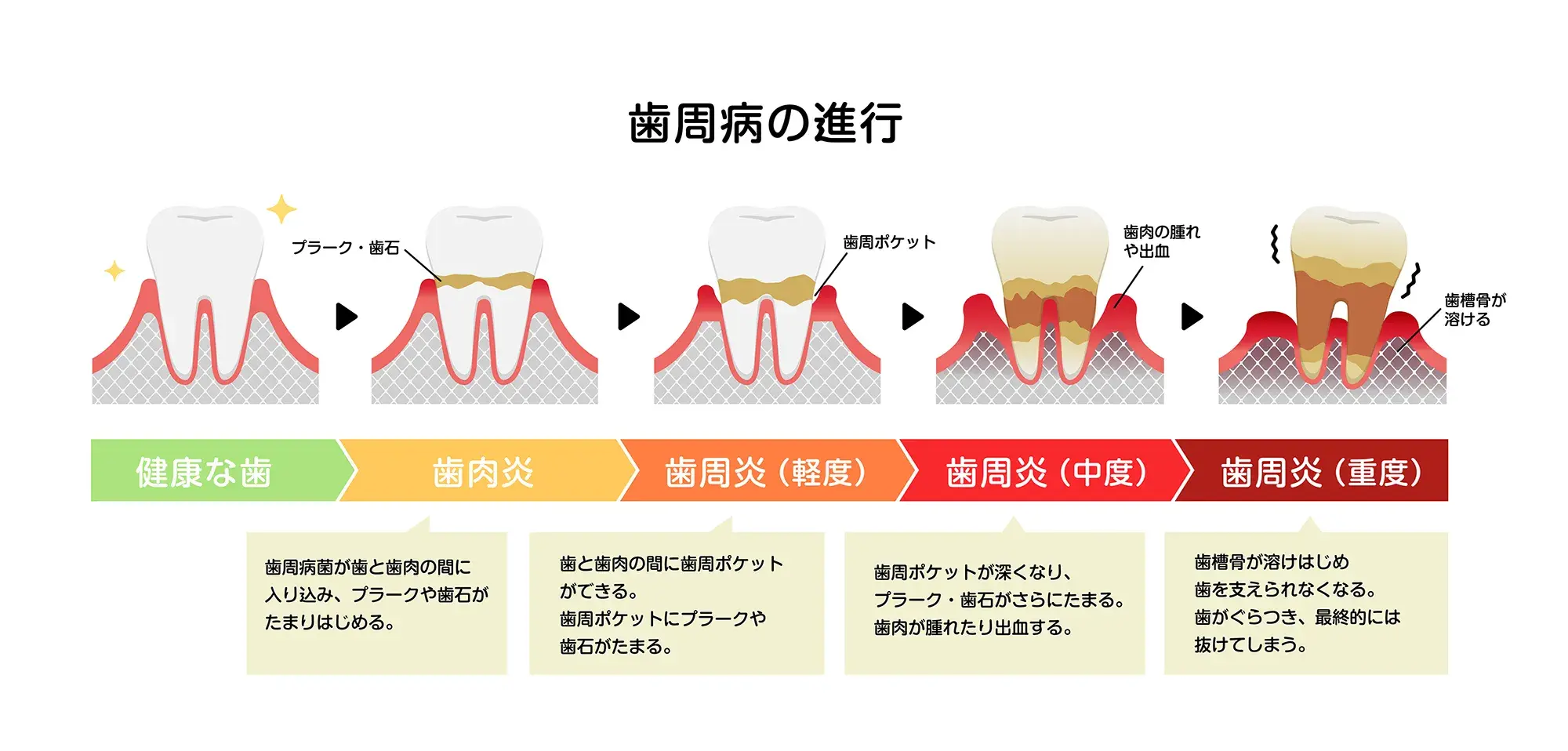 歯周病の進行