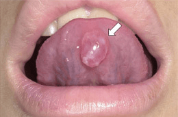 ブランディン・ヌーン嚢胞（前舌腺）