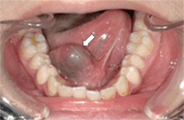 がま腫（舌下腺）